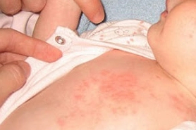 Çocuklarda isilik tehlikesine dikkat