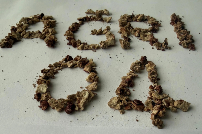 21 kez ameliyat olmuştu, bu kez 295 taş çıkarıldı