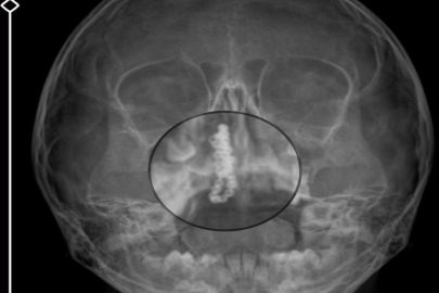 5 yaşındaki Polen, 2 yıldır burnunda tırnak makası zinciriyle yaşamış