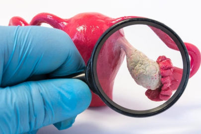 Uzman açıkladı: Kadınlarda şiddetli adet ağrısının nedeni çikolata kisti olabilir