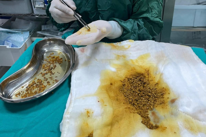 Karın ağrısı şikayetiyle gitti, safra kesesinden 2 bin 67 taş çıkarıldı