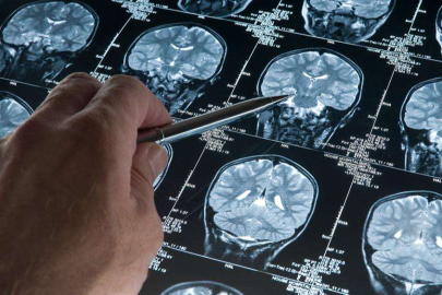 Araştırma: Alzheimer düşünüldüğünden daha erken başlayabilir